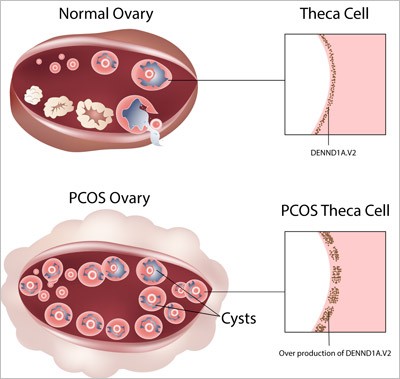 PCOS & PCOD— Facing the Facts